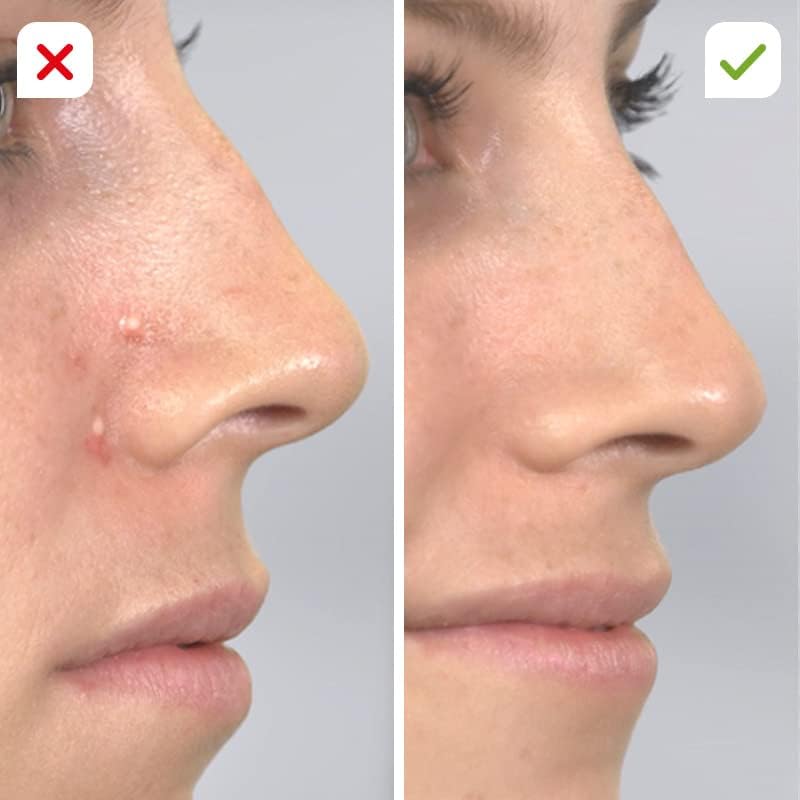 Derma Suction Pore Cleaner – Blackhead Remover Vacuum Device