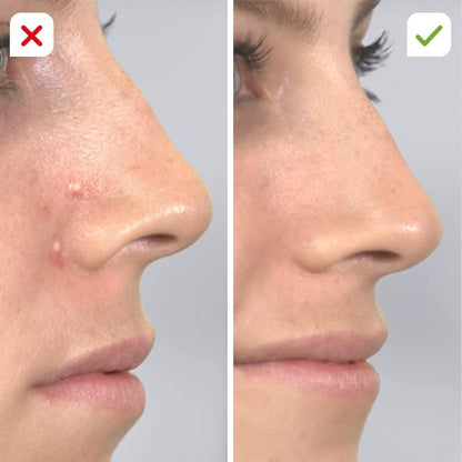 Derma Suction Pore Cleaner – Blackhead Remover Vacuum Device
